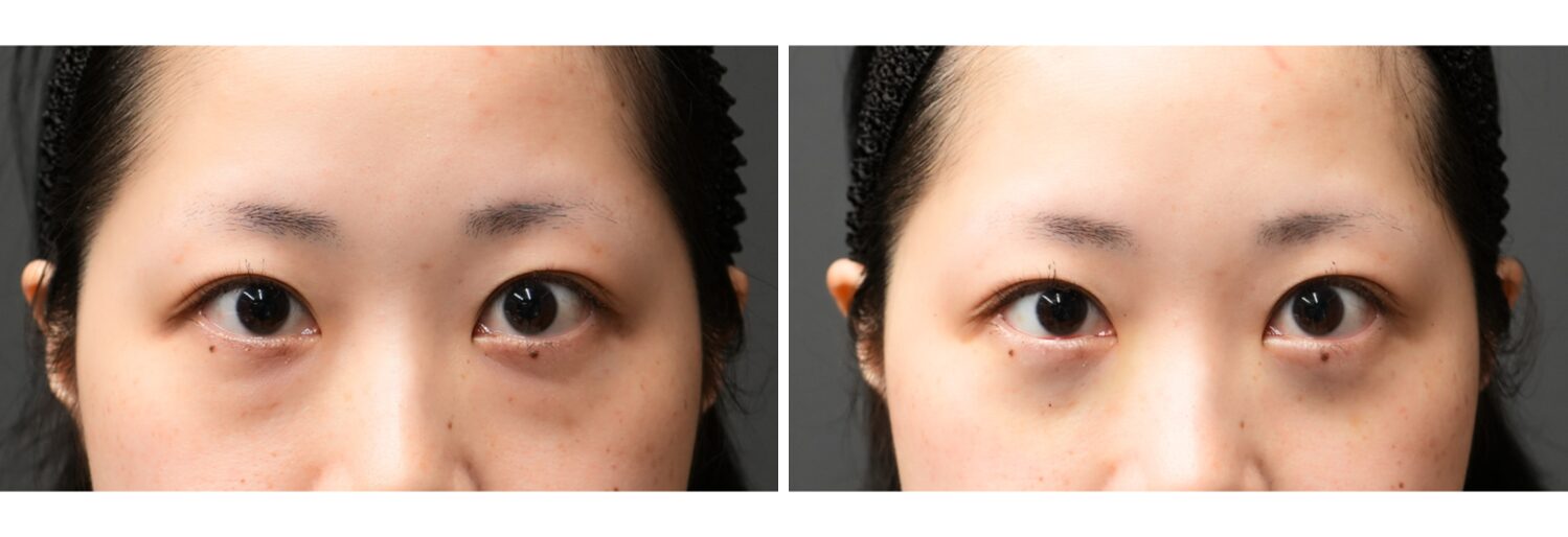 目の下のふくらみ取り