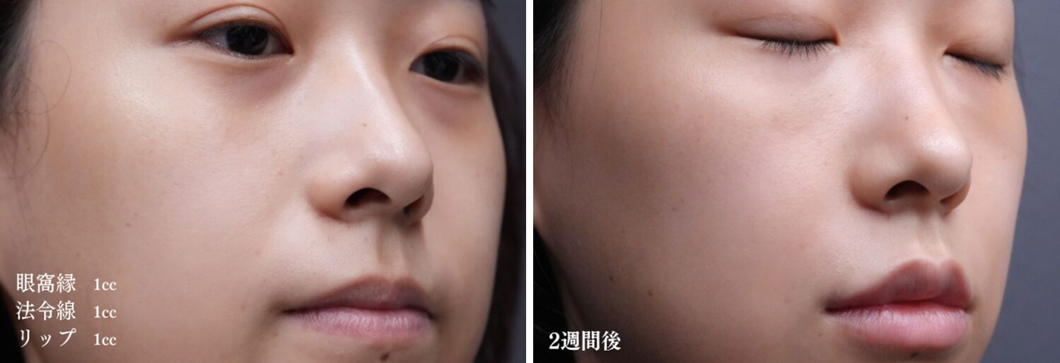 ヒアルロン酸複合（眼窩縁・ほうれい線・リップ）