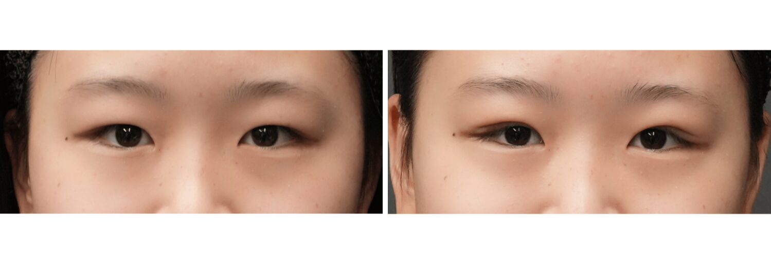 埋没法　３点留