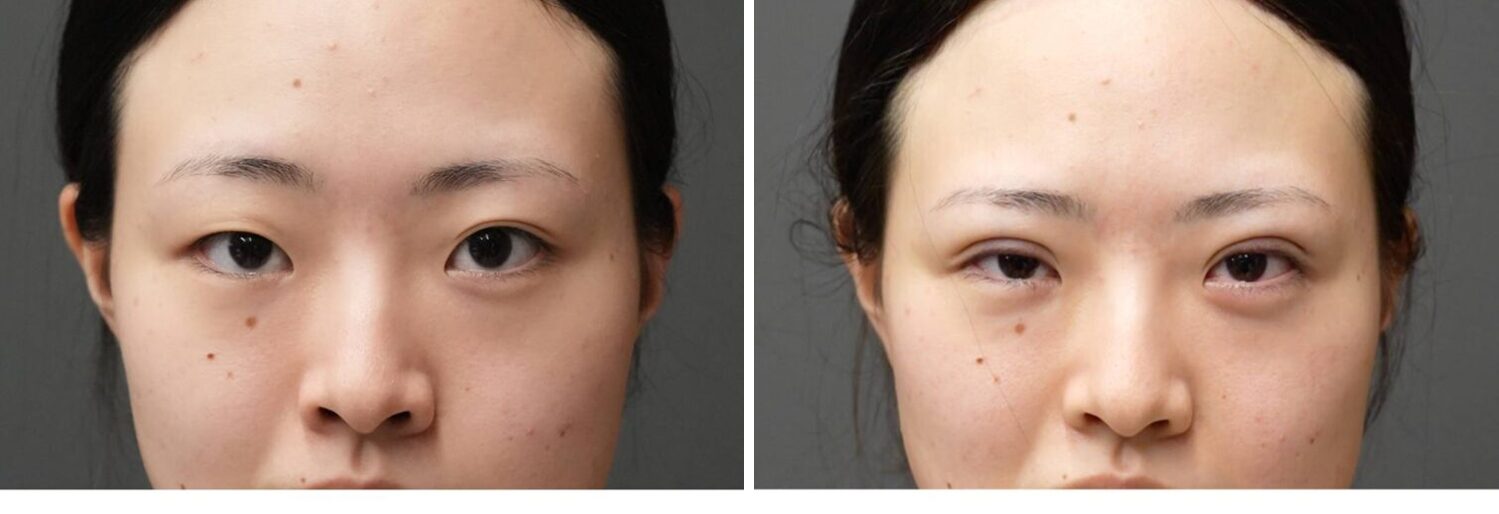 埋没法　３点留