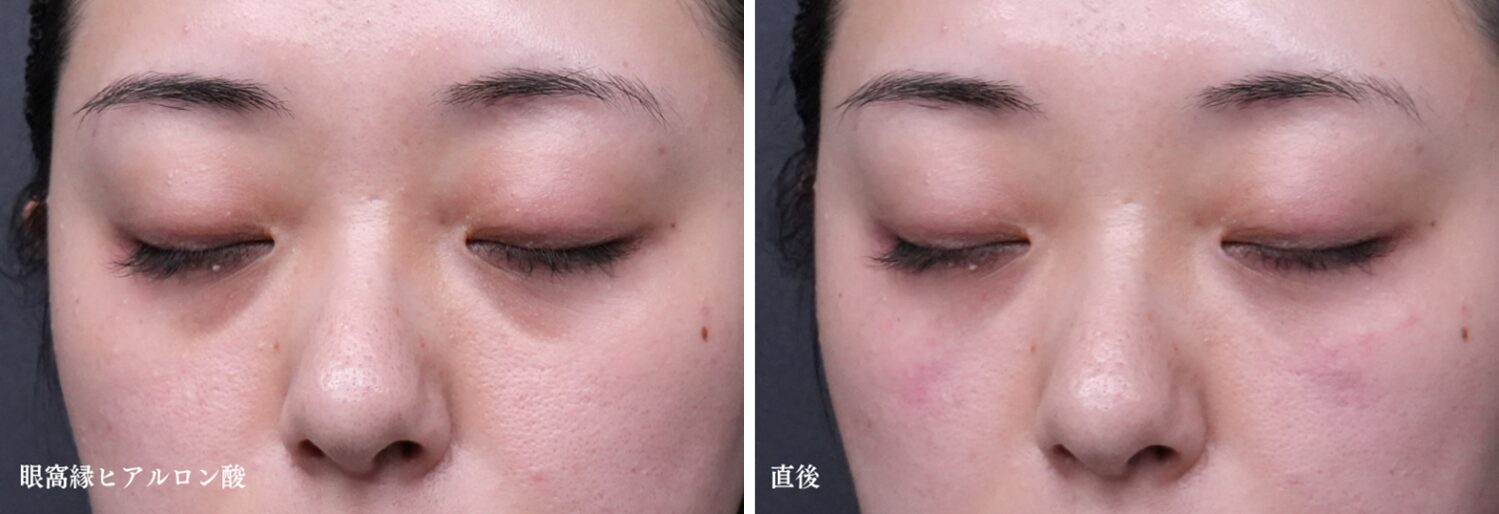 眼窩縁ヒアルロン酸