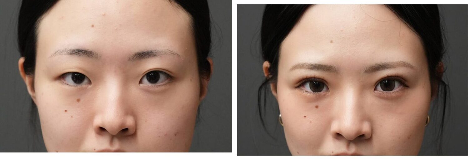 埋没法　３点留