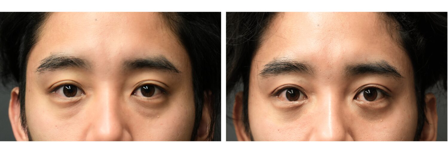 目の下のふくらみとり