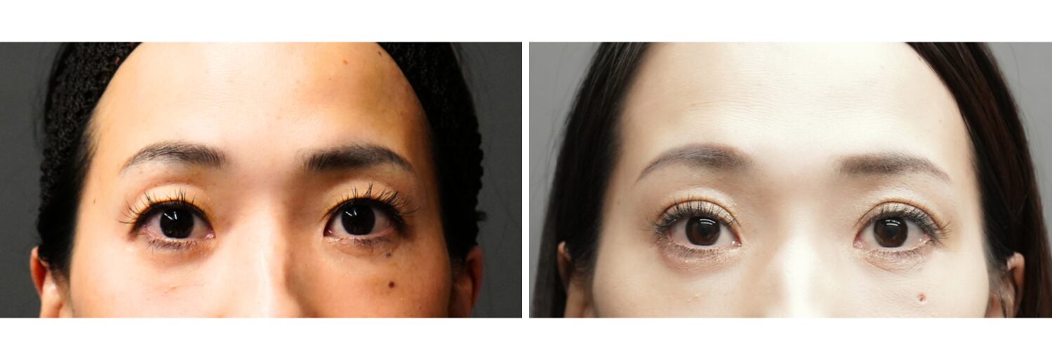 埋没法　３点留