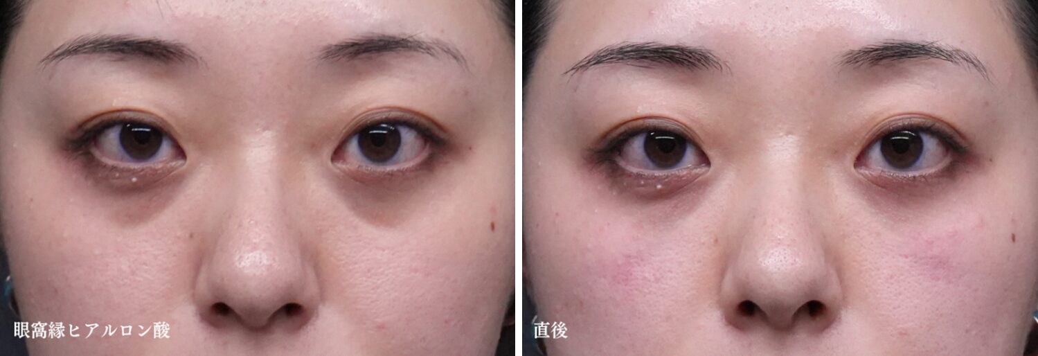 眼窩縁ヒアルロン酸