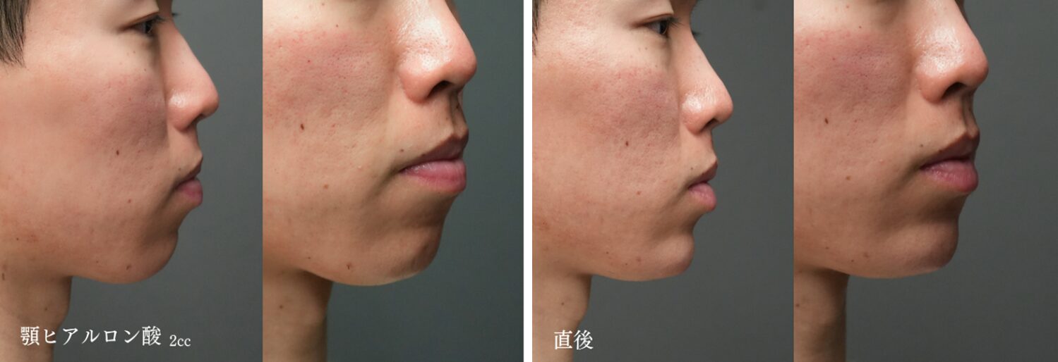 アゴのヒアルロン酸