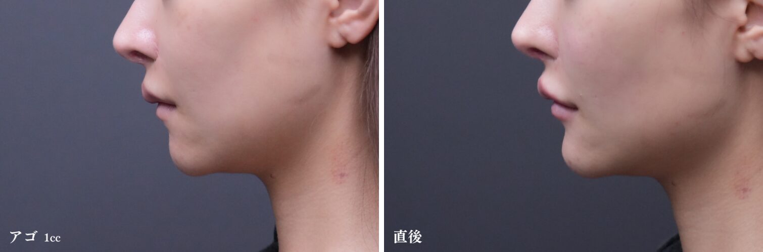 アゴのヒアルロン酸