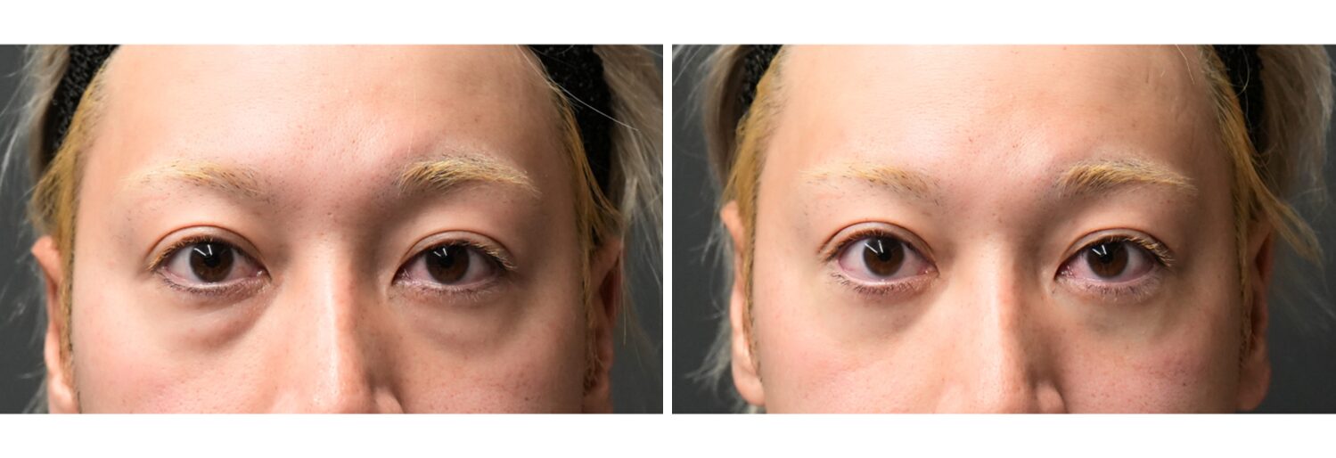 目の下のふくらみとり