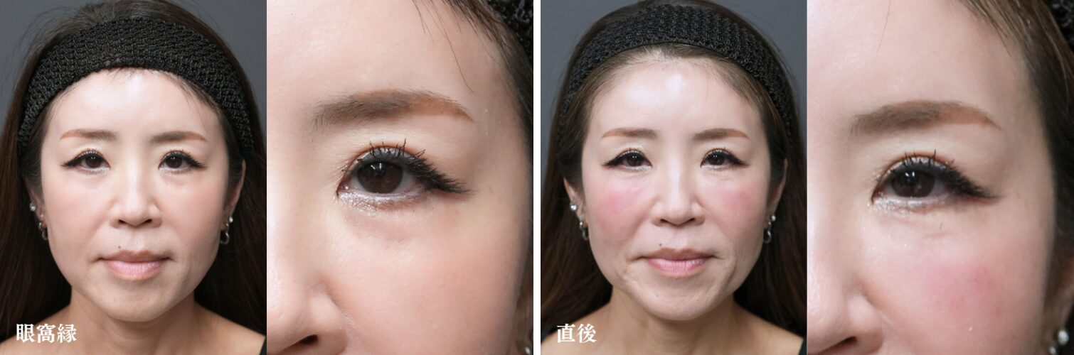 眼窩縁ヒアルロン酸