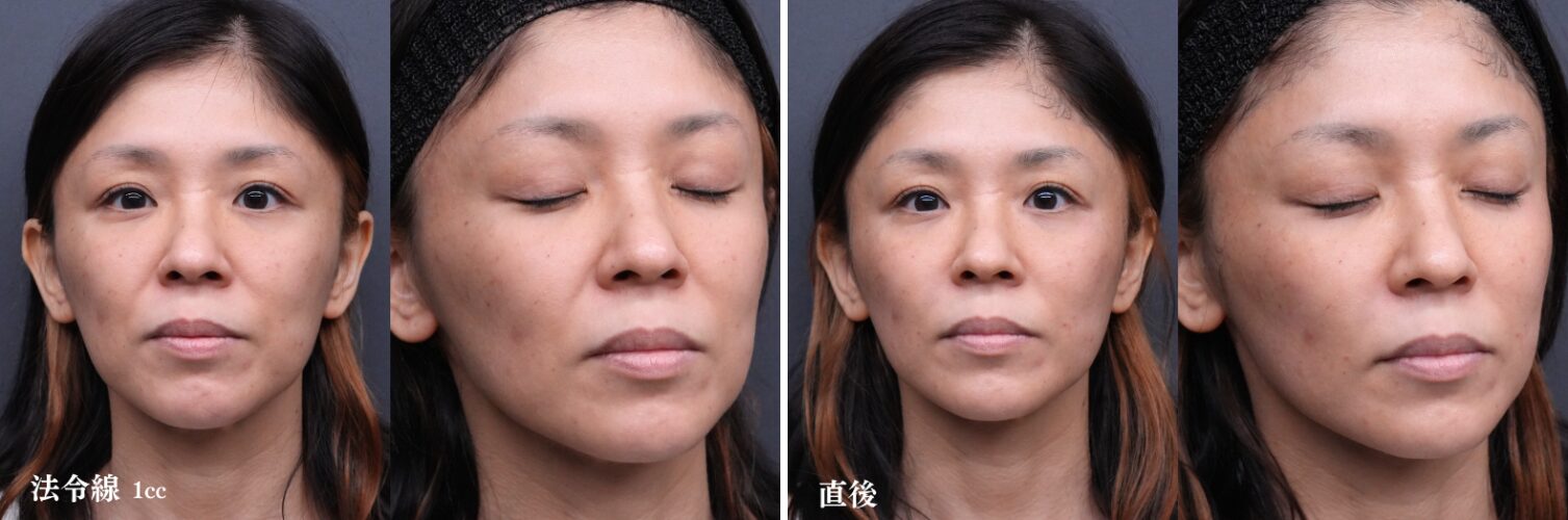 ほうれい線ヒアルロン酸