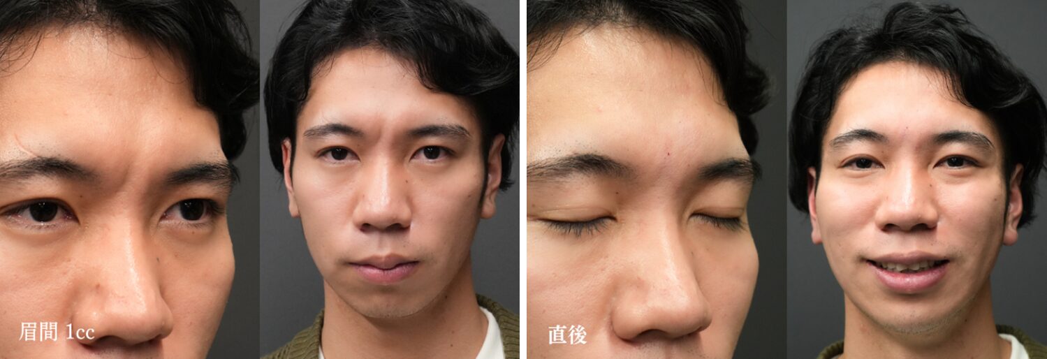 ヒアルロン酸（眉間）