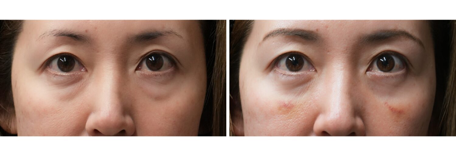 目の下のふくらみとり