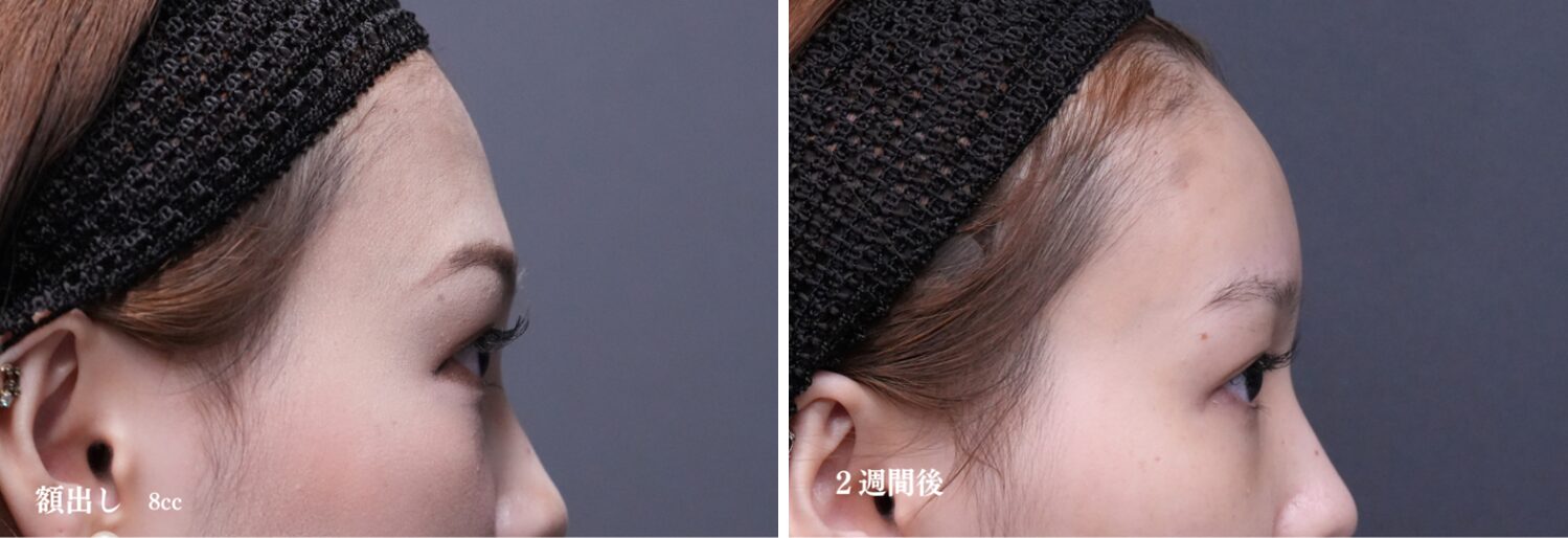 額だしヒアルロン酸