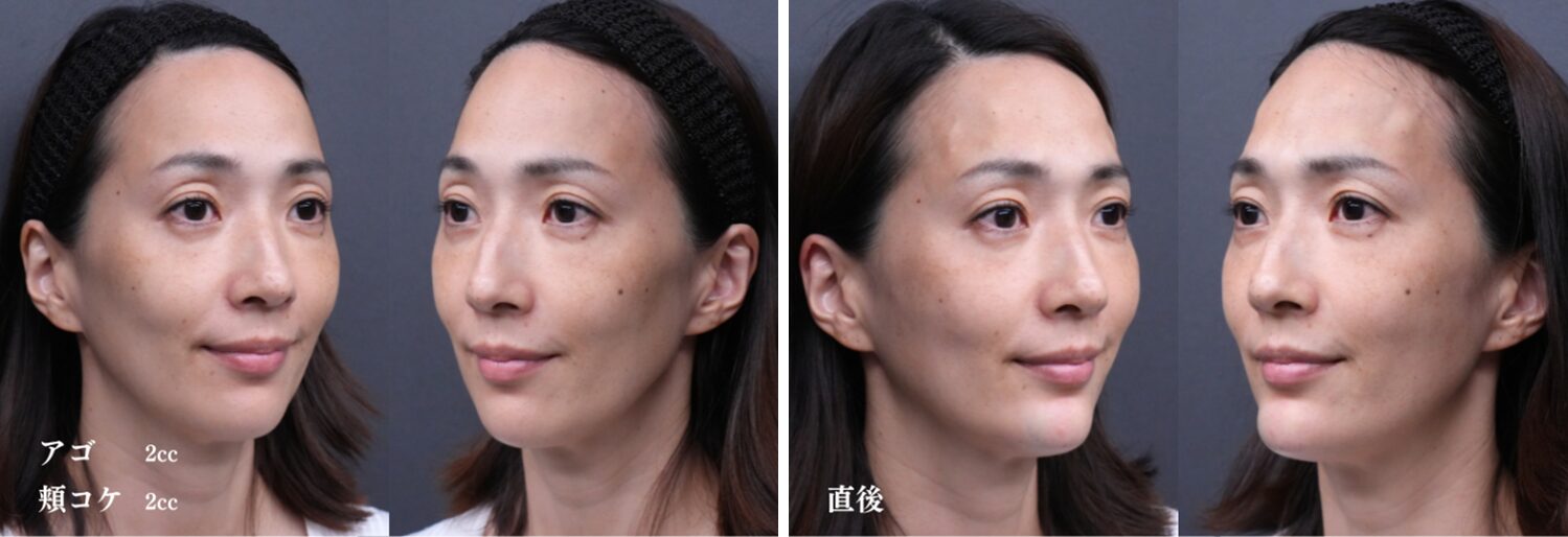ヒアルロン酸複合症例（頬こけ・アゴ）