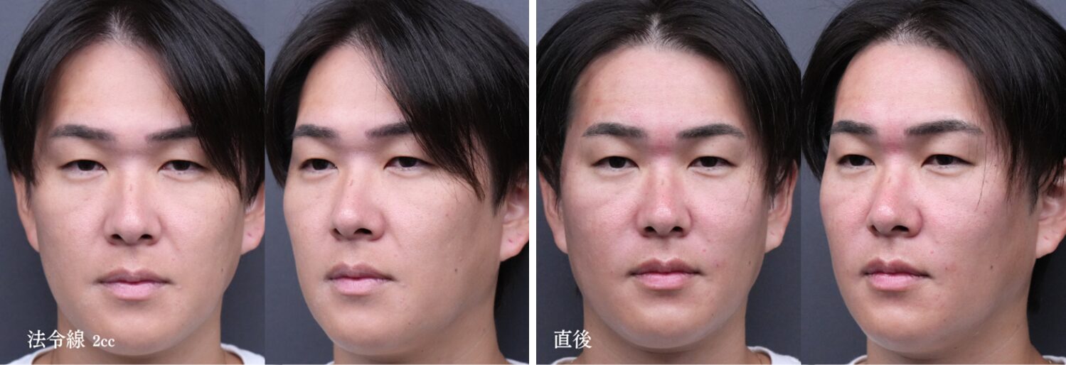 ほうれい線ヒアルロン酸