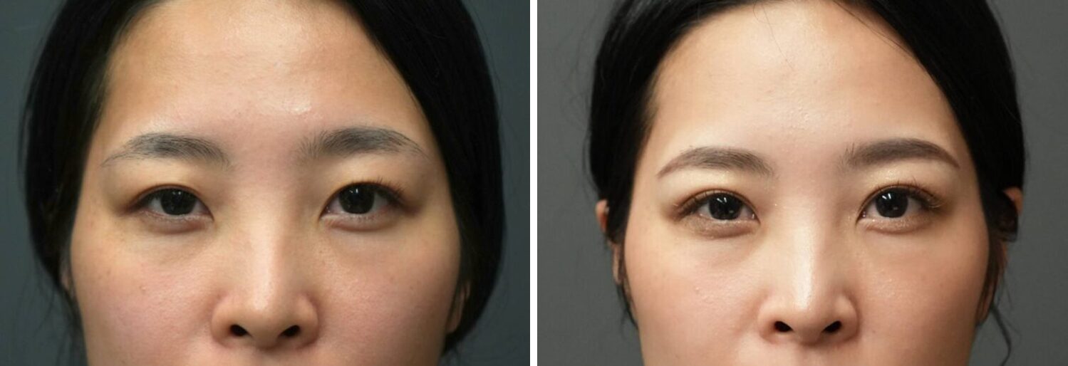 埋没法　３点留