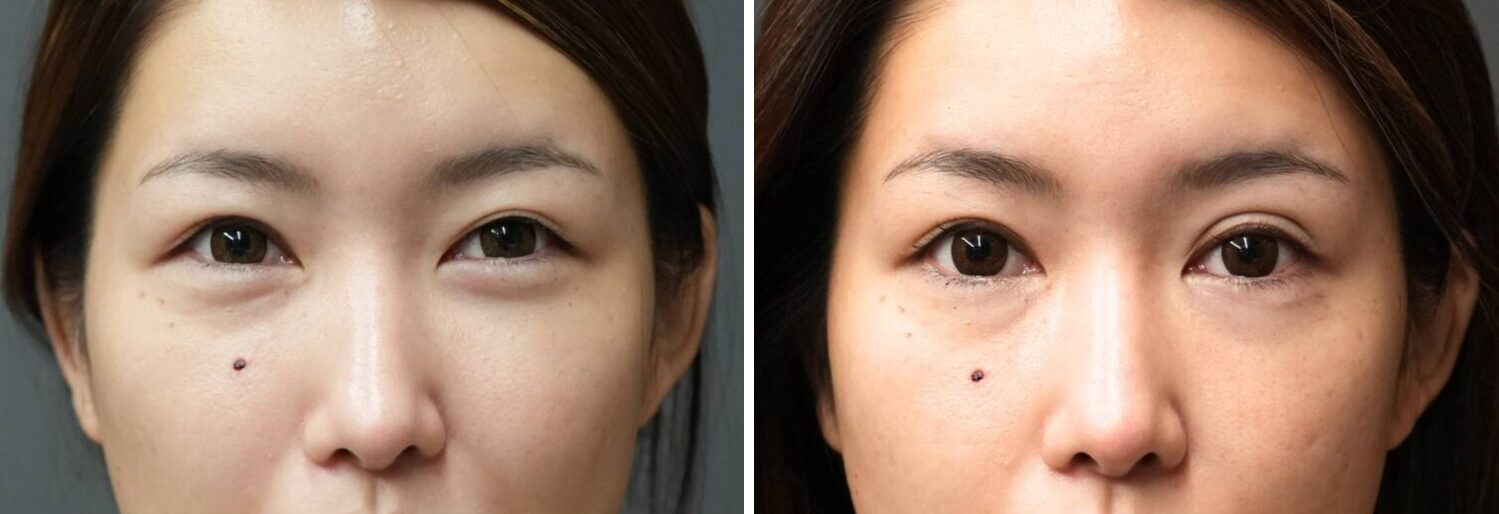 埋没法　３点留（左）