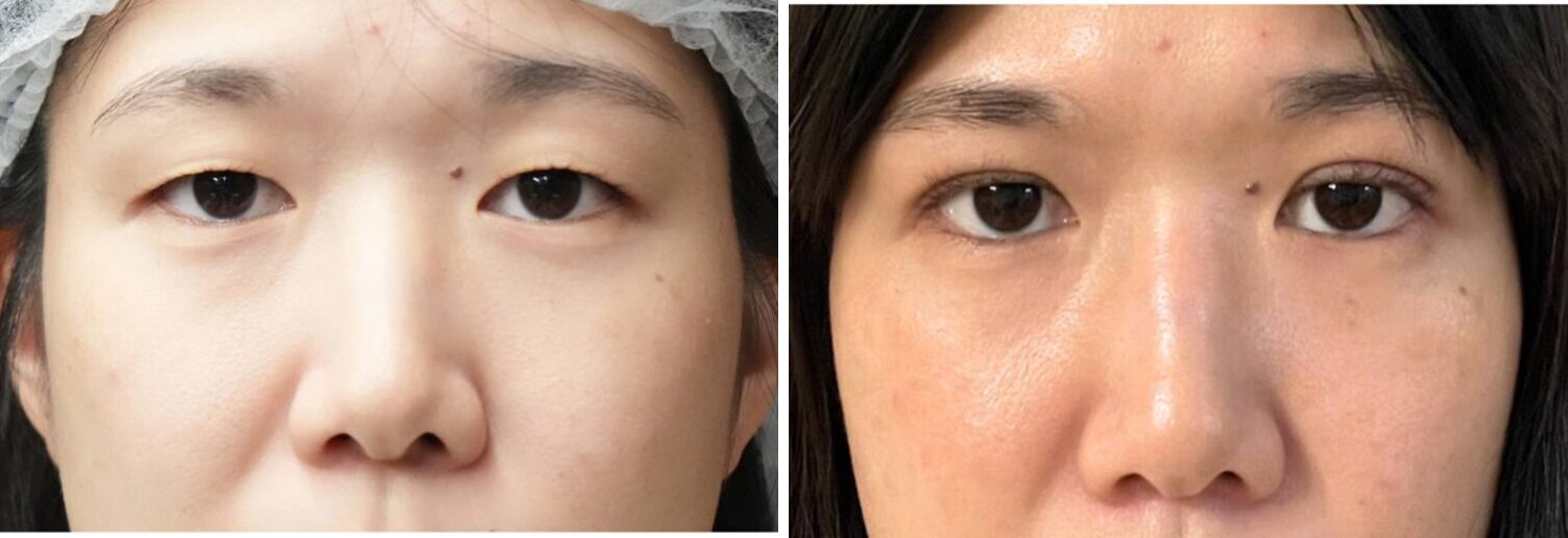 埋没法　３点留