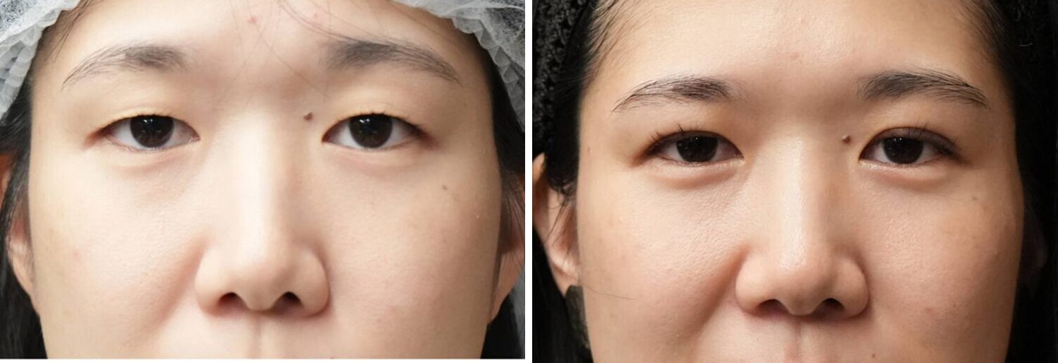 埋没法　３点留