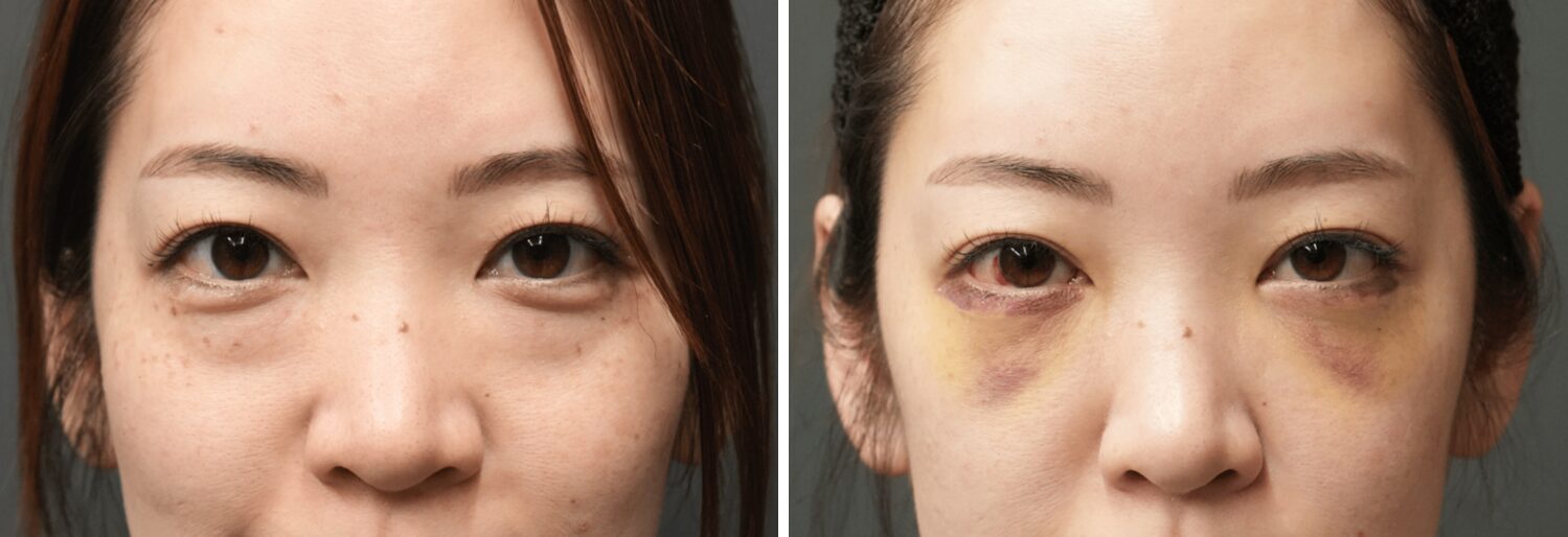 目の下のふくらみとり