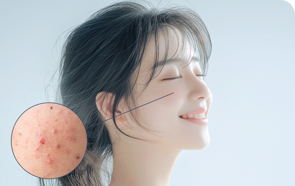 ニキビ・角質除去